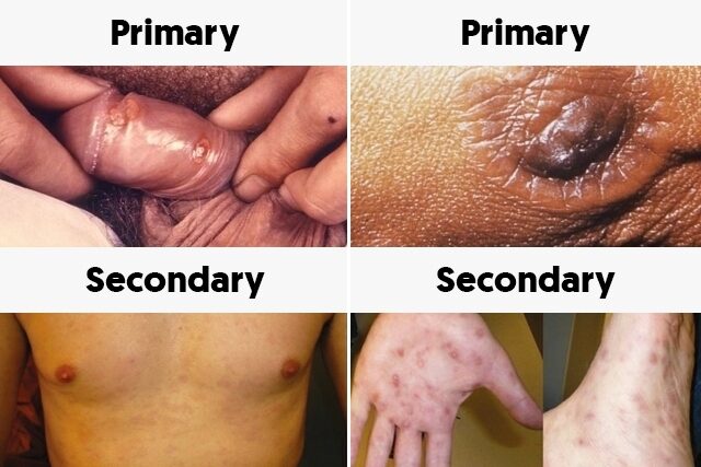 อาการsyphilis