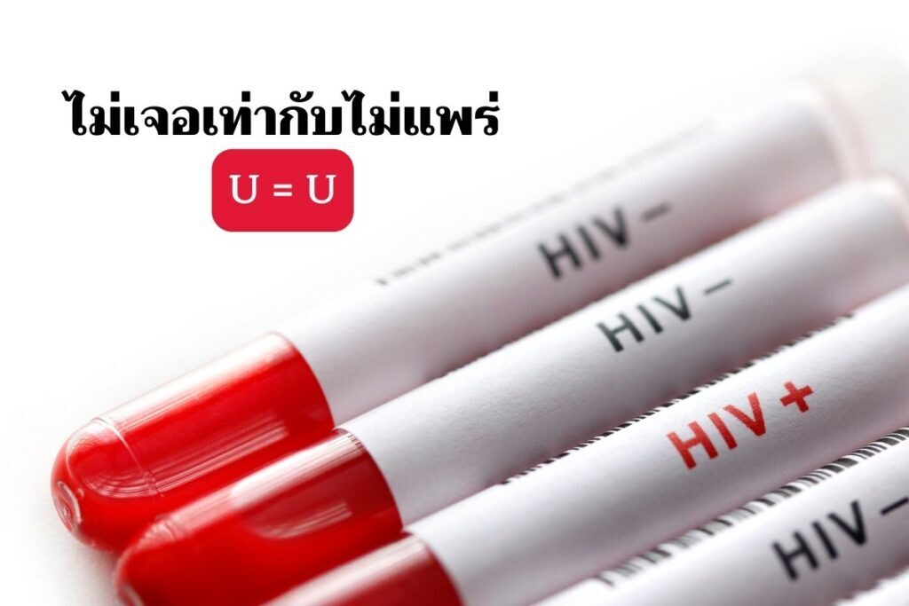 U=U ไม่เจอเท่ากับไม่แพร่ ตรวจไม่พบเชื้อหมายความว่าอย่างไร