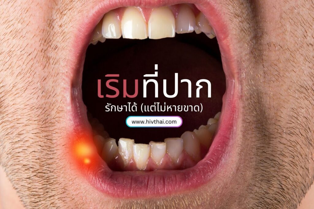 เริมที่ปาก..รักษาได้(แต่ไม่หายขาด)
