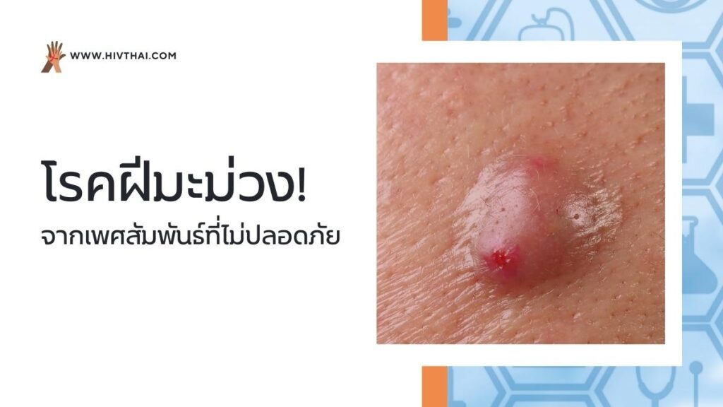 โรคฝีมะม่วง จากเพศสัมพันธ์ที่ไม่ปลอดภัย